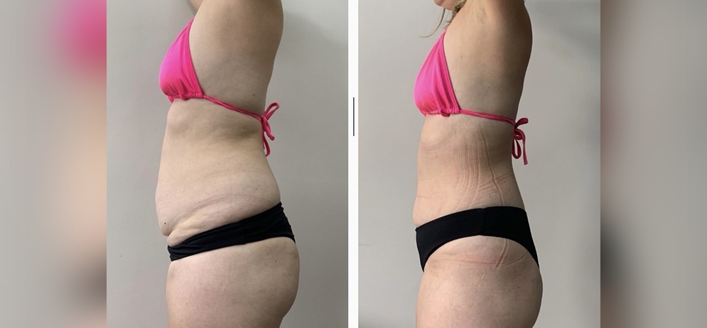 Antes e depois 1